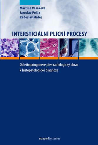 Procese pulmonare interstițiale